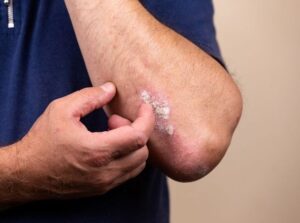 أعراض جفاف الجلد وتأثيره على صحة البشرة