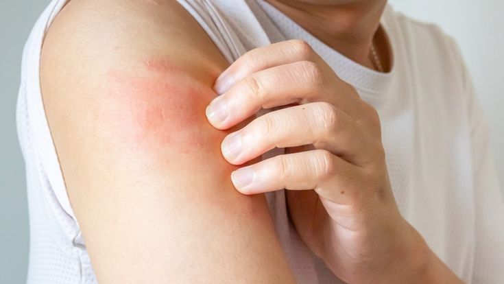 طرق علاج جفاف الجلد باستخدام الترطيب اليومي