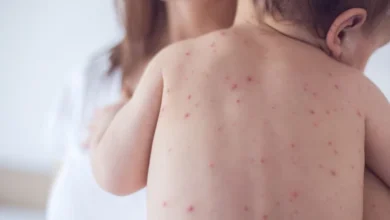 تفشي مرض الحصبة في الولايات المتحدة