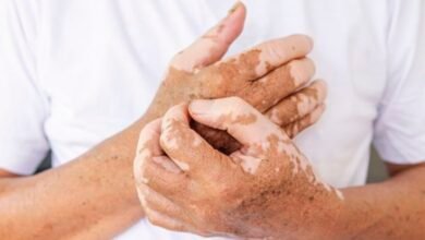 حبة دواء تعيد لون البشرة لدى مصابي البهاق