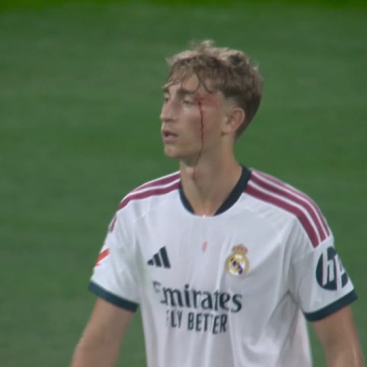 ريال مدريد يترقب حالة هويسن بعد إصابته أمام إسبانيول